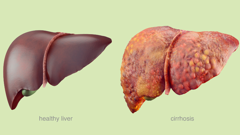 Liver cirrhosis